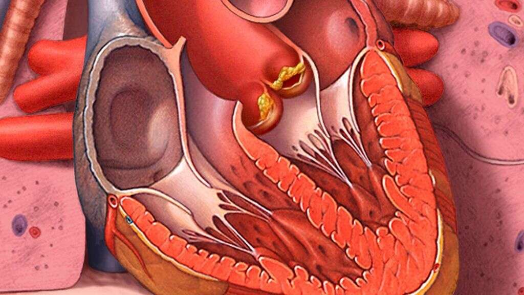 endocarditis-what-is-endocarditis