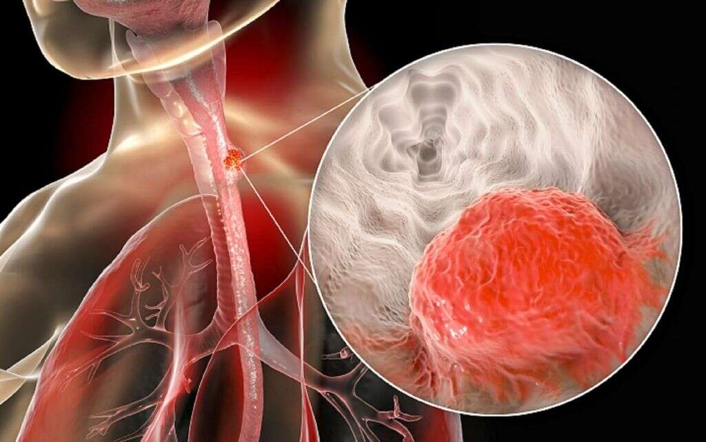 Esophageal Cancer