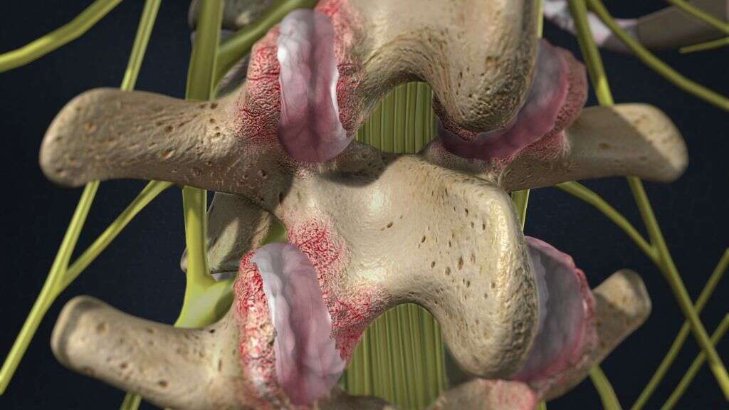 facet-arthropathy-what-is-facet-arthropathy