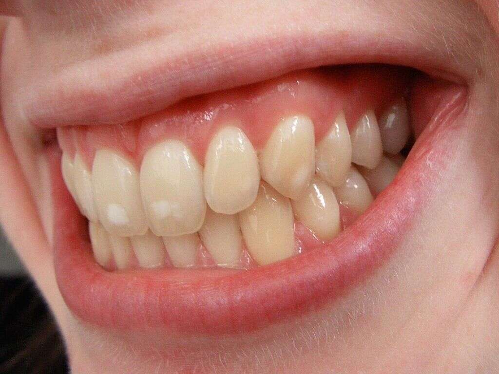 What Is Fluorosis?