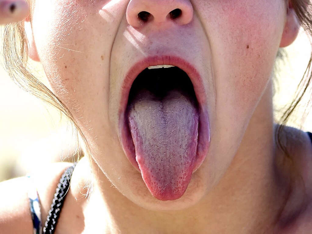 What Is Hairy Tongue?