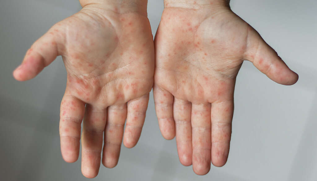 Hand, Foot, and Mouth Disease