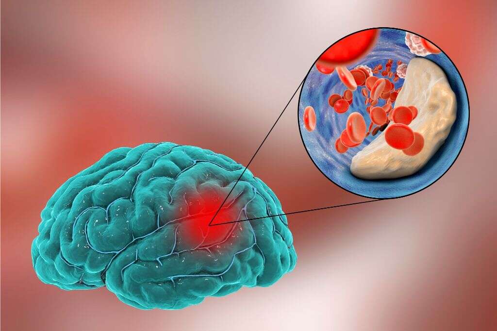 ischemia-what-is-ischemia