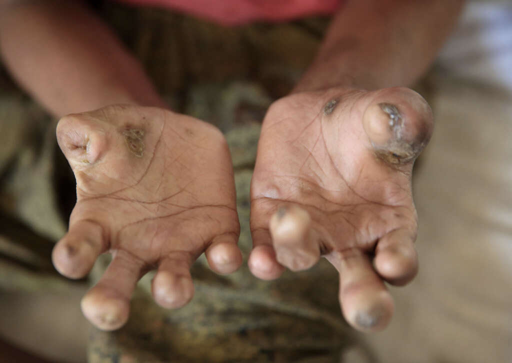 Leprosy What Is Leprosy 