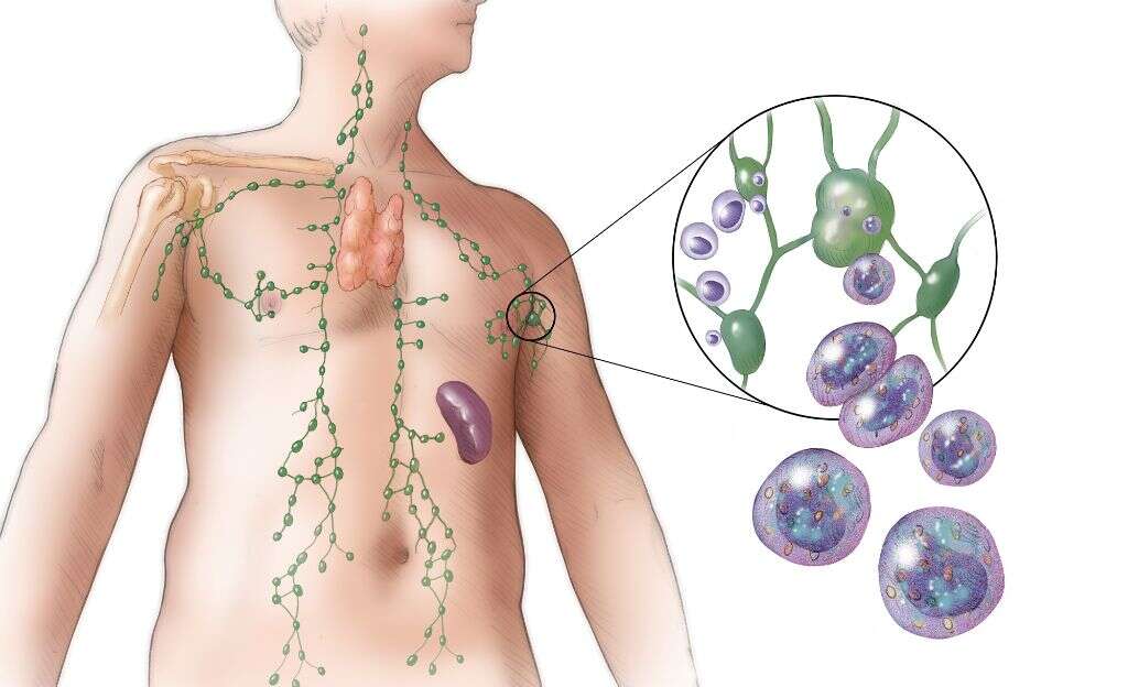 Does Lymphoma Cause Bruising