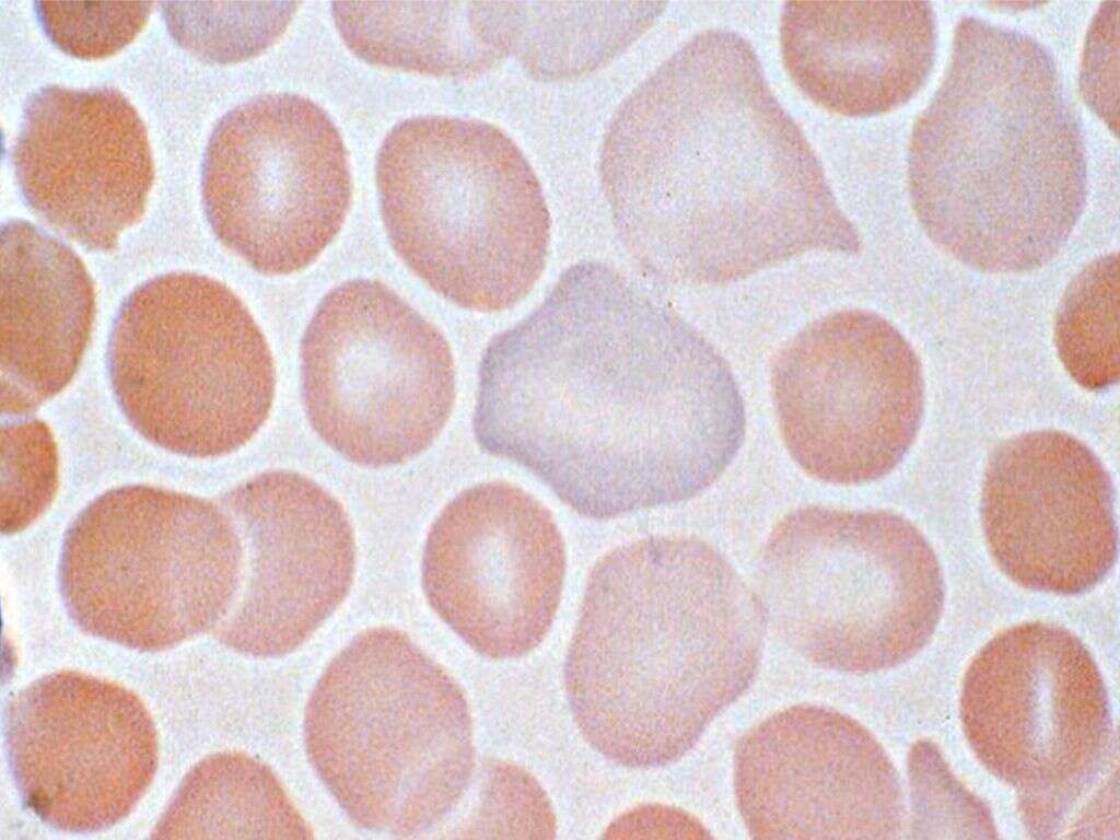 Microcytic Anemia