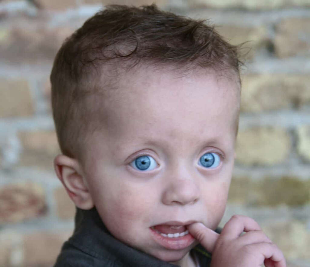 Pics Of Noonan Syndrome