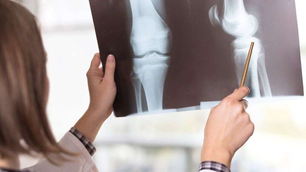 Osteoarthritis