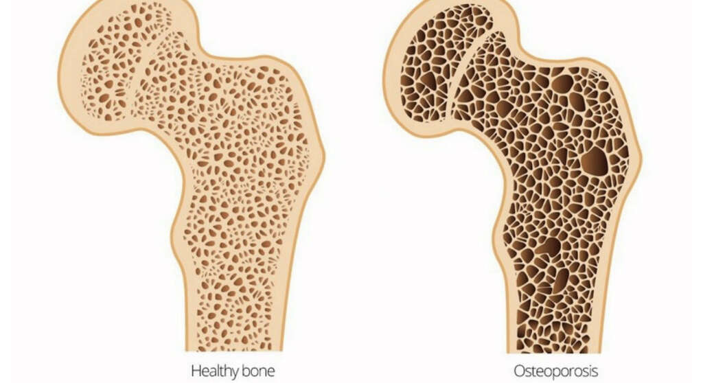 Osteomalacia