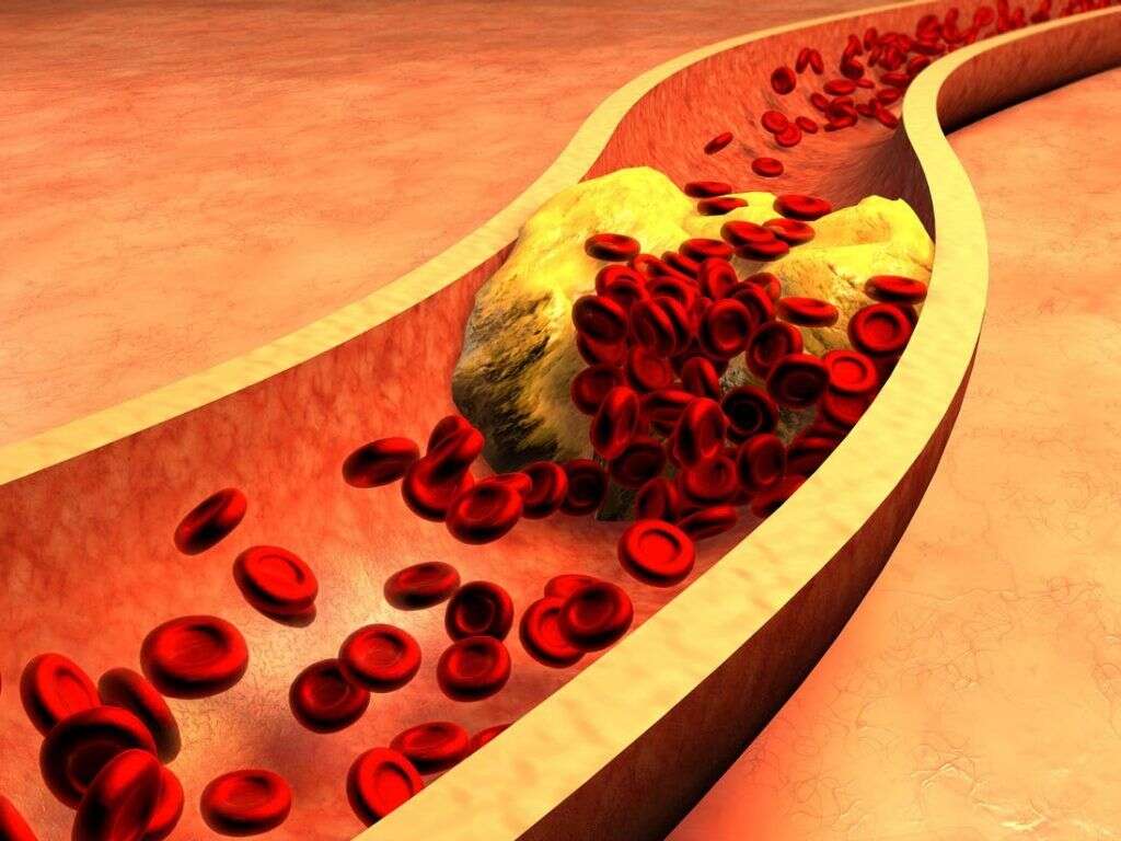 What Is Oxidized Cholesterol?