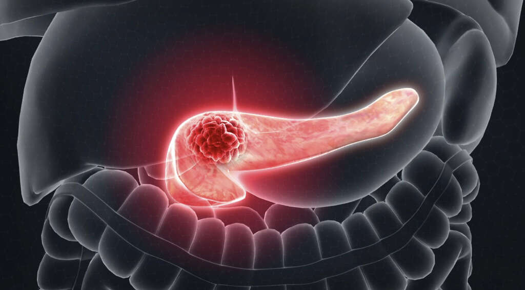 pancreatic pancreas etiology