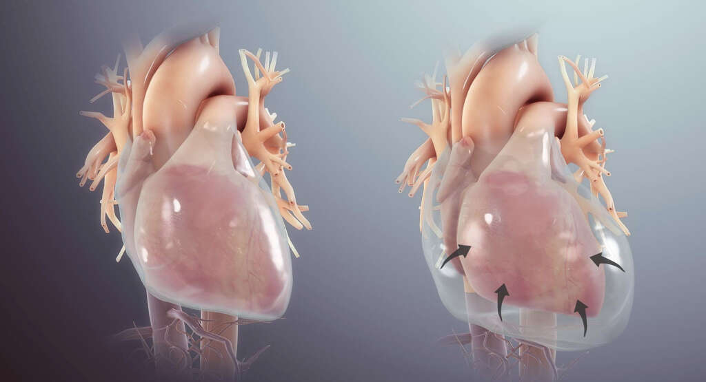 Pericardial Effusion