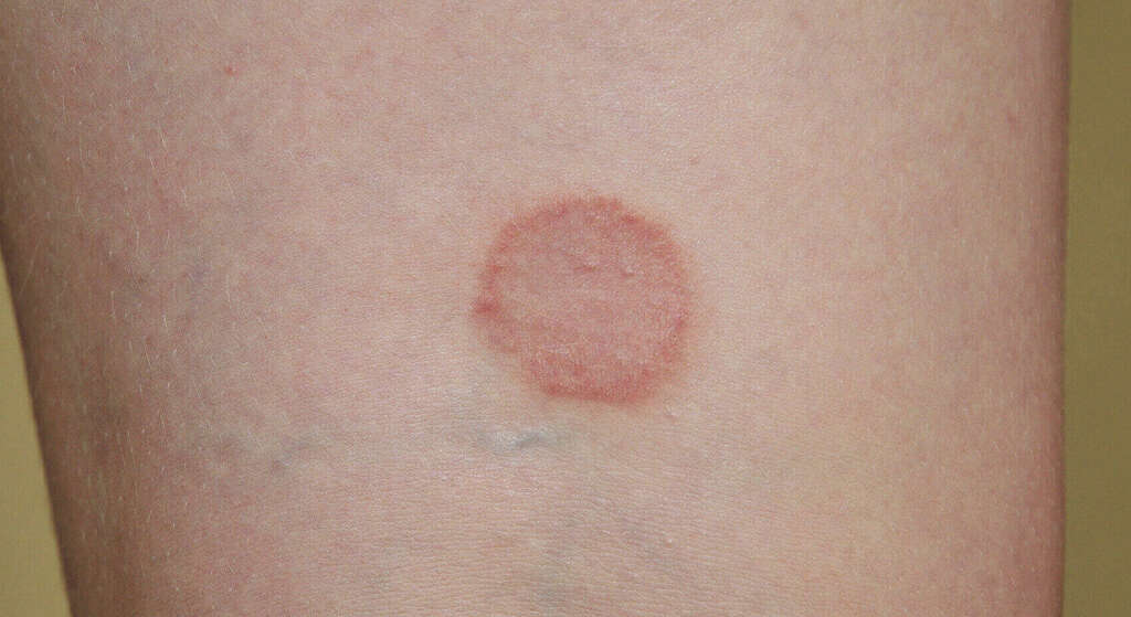 Pityriasis Rosea