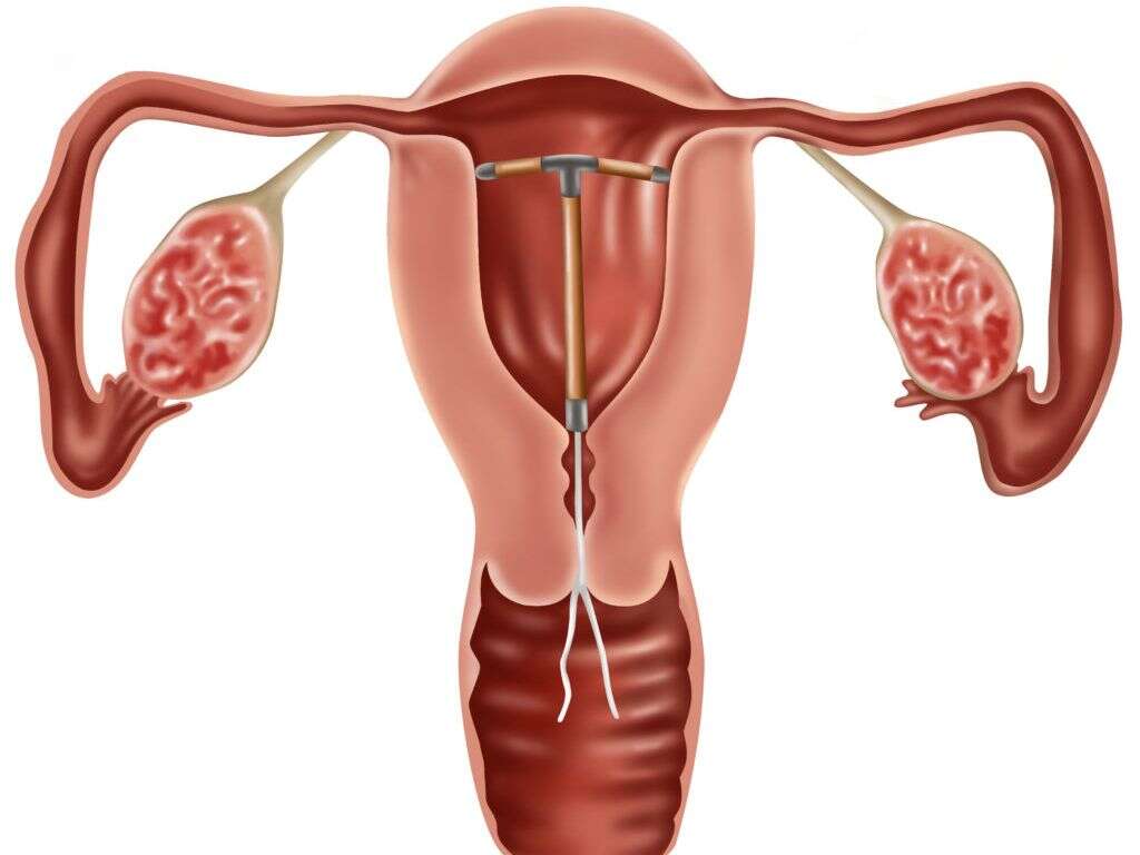 What Is Polycystic Ovary Syndrome?