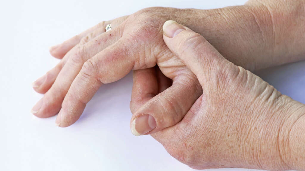 Psoriatic Arthritis