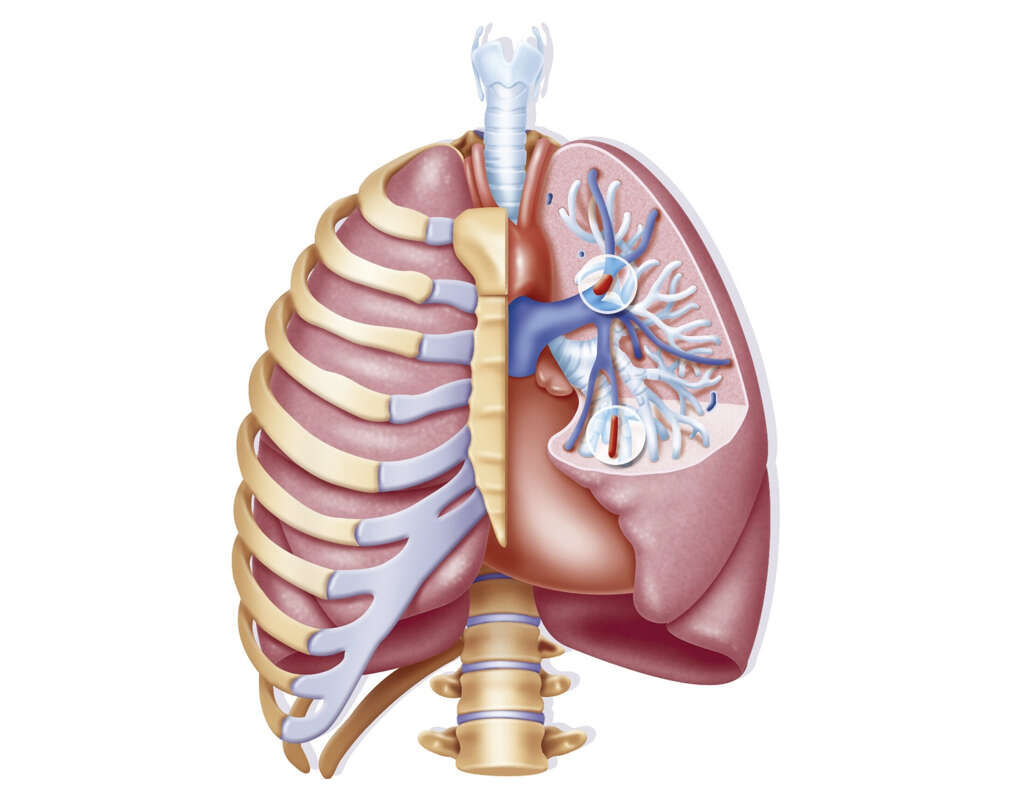 pulmonary-edema-what-is-pulmonary-edema