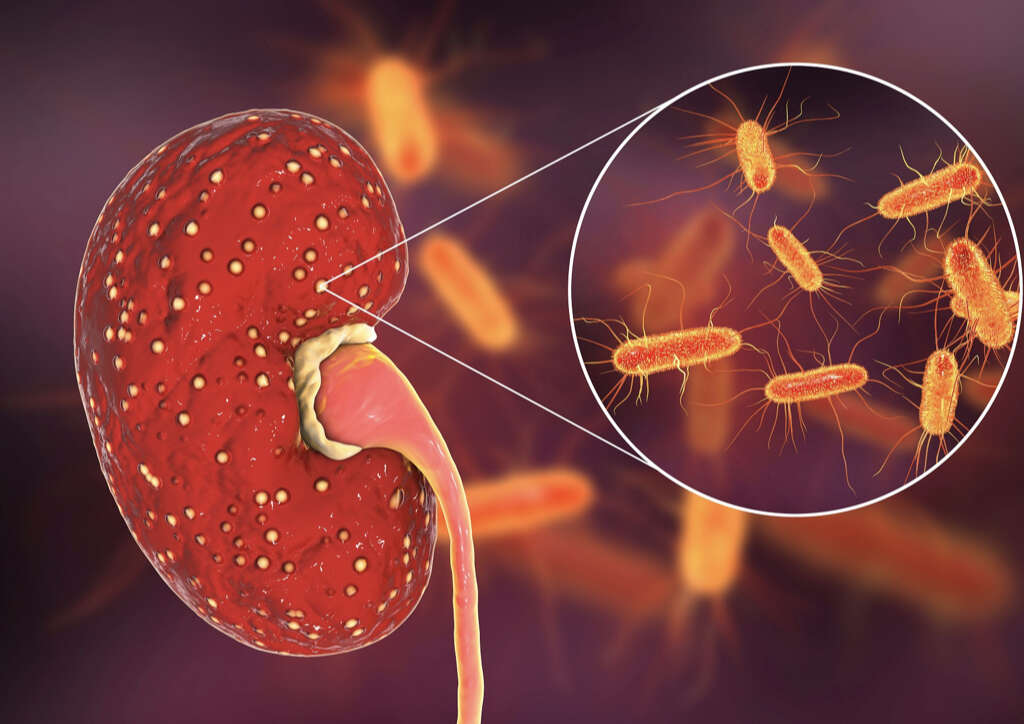 Pyelonephritis