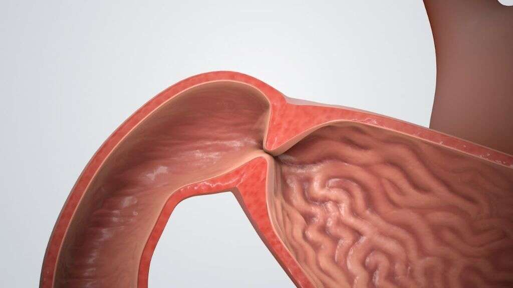 Pyloric Stenosis