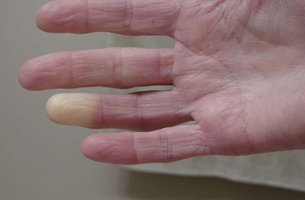 Raynaud's Phenomenon