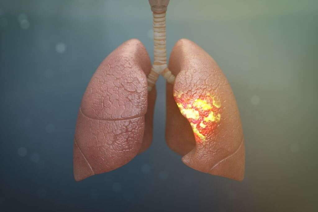 What Is Respiratory Distress Causes