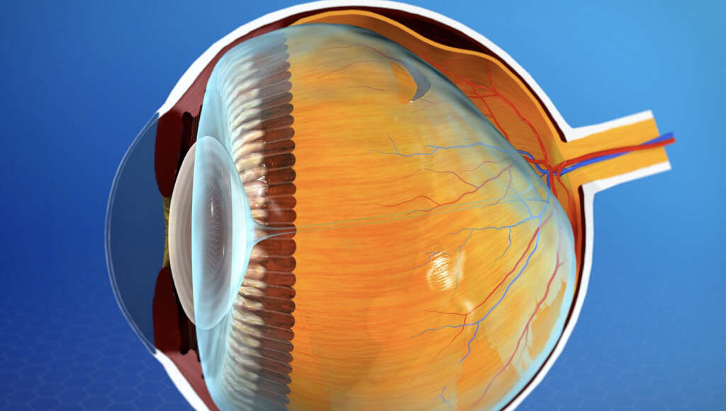 Retinal Detachment