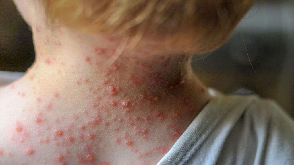 Roseola