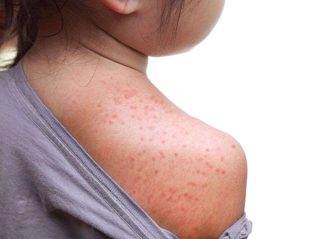 roseola-infantum-what-is-roseola-infantum