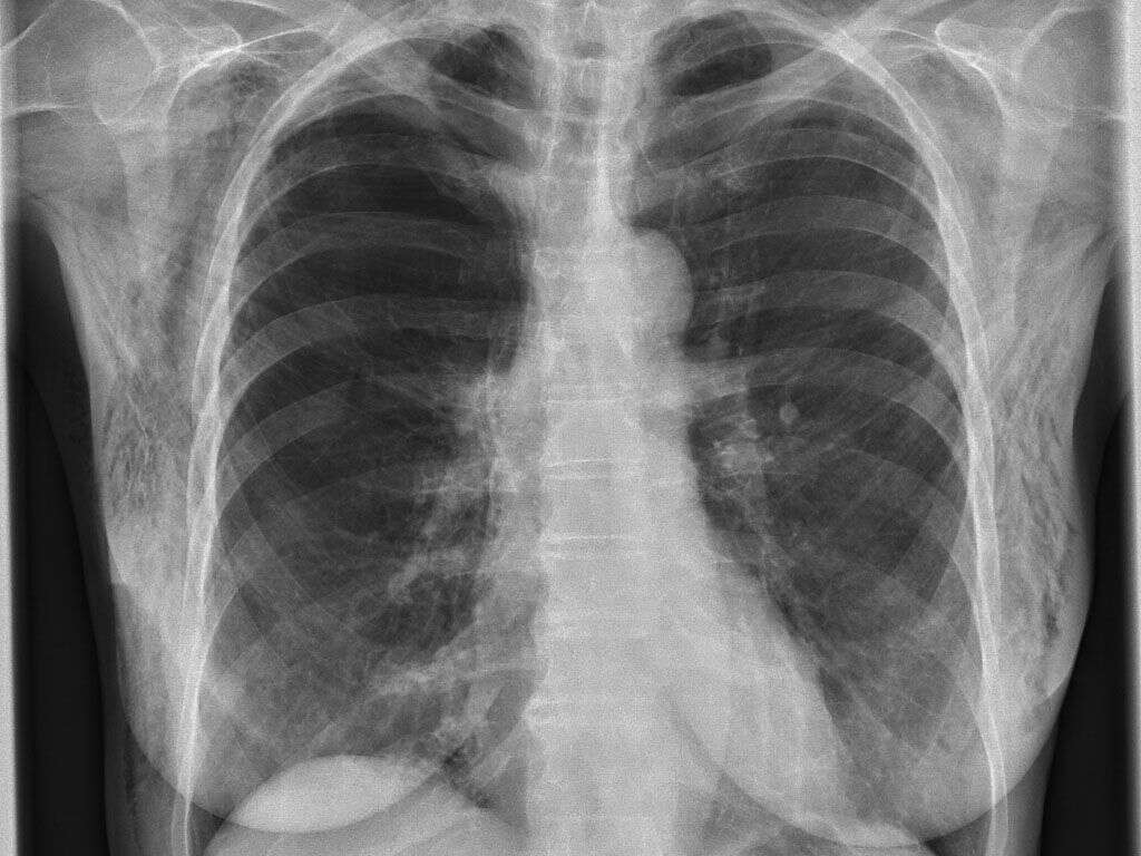 What Is Subcutaneous Emphysema?