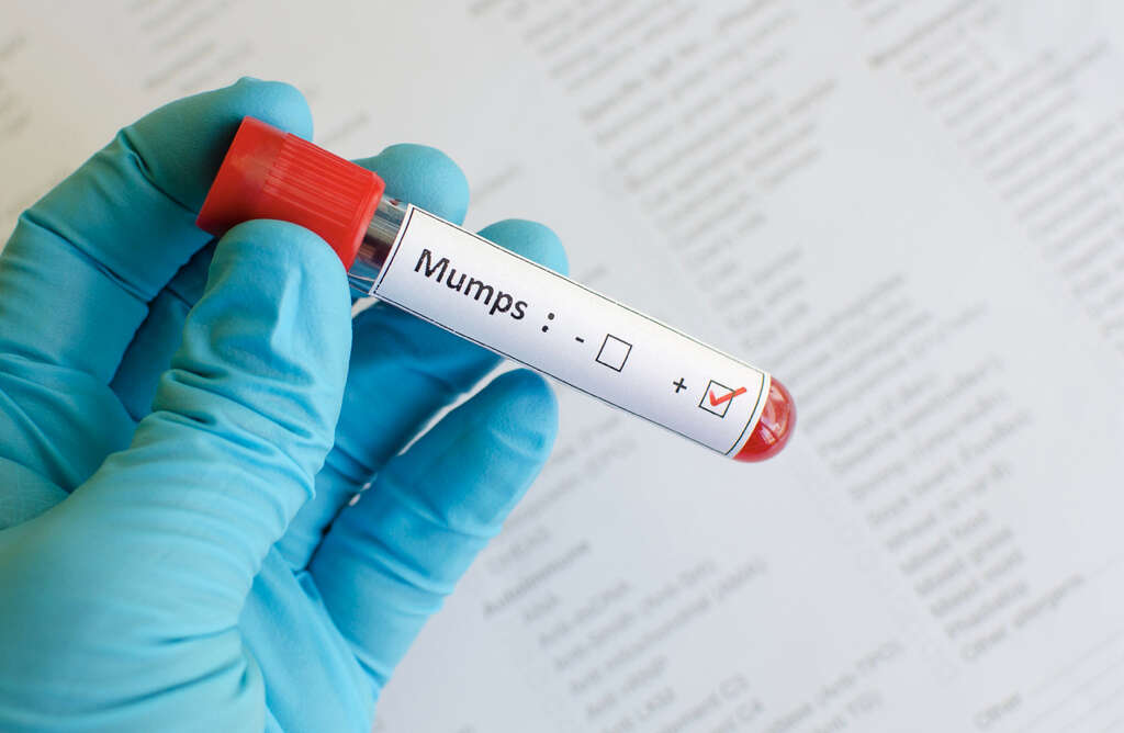 Mumps