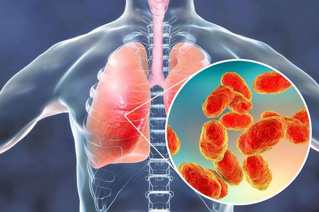 Tracheitis