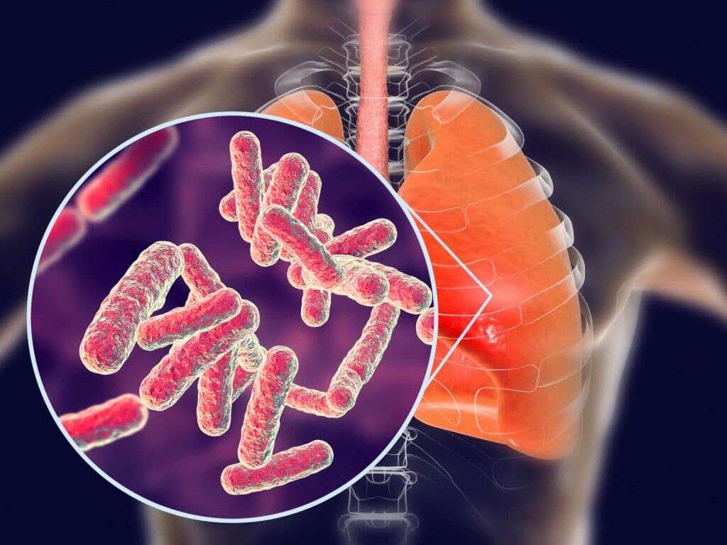 What Is Tuberculosis?