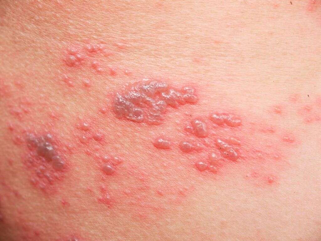 Varicella