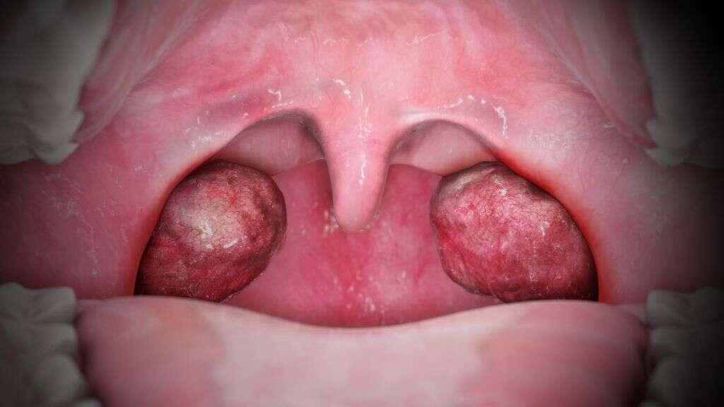 Viral Tonsillitis