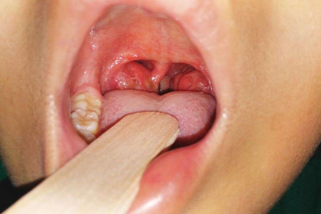 Viral Tonsillitis