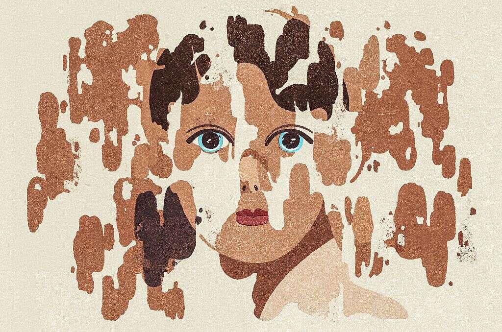vitiligo universalis