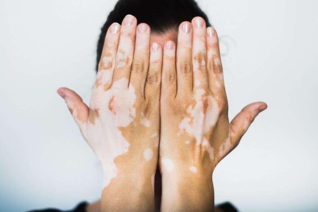 Gambar Vitiligo