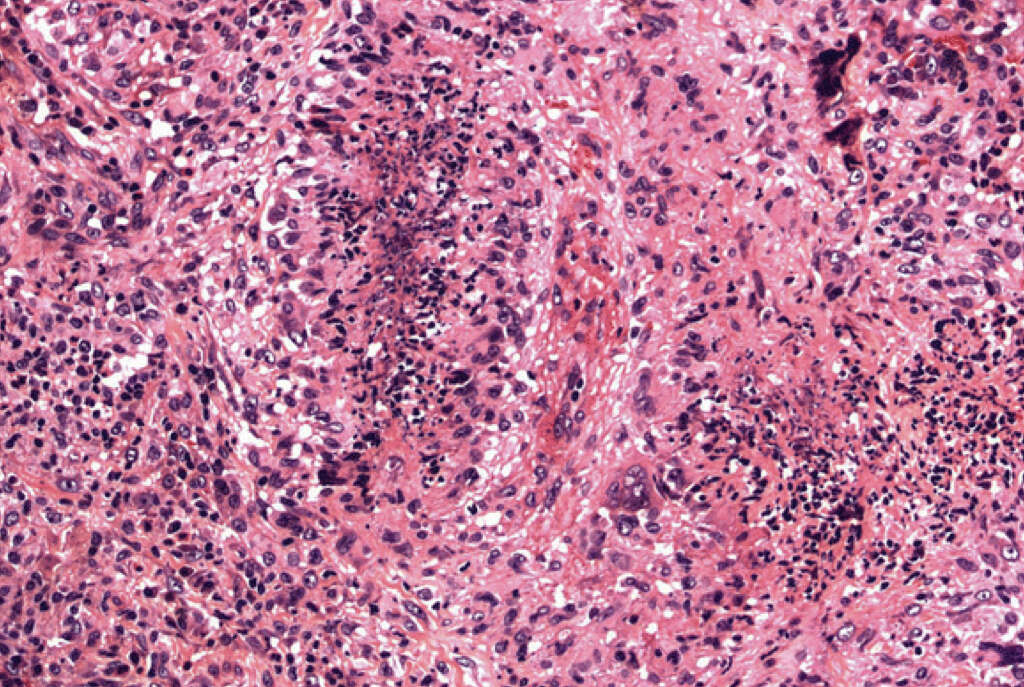 Wegener's Granulomatosis